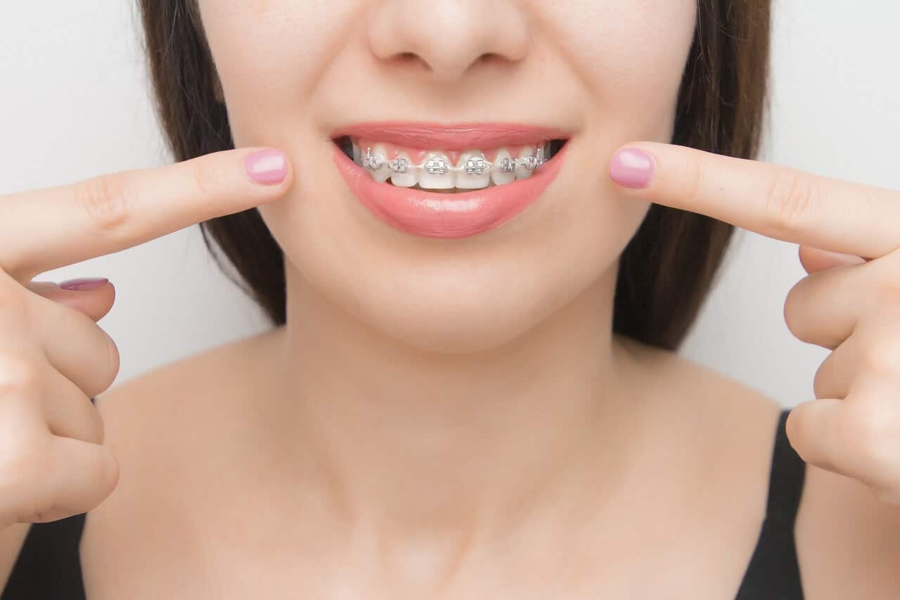 brackets metálicos